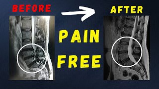 L4 L5  L5 S1 disc herniation recovered pain free without surgery [upl. by Sinaj]