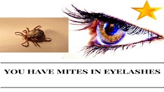 You have mites on your eyelashes [upl. by Fellner]