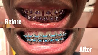 Process of Getting Braces [upl. by Ahsilahk]