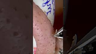 Skincare  Blackheads Removal 164 skincare skincare blackheads blackheads [upl. by Heigho]