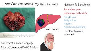 Liver angiosarcoma  Symptoms and treatment liver angiosarcoma prognosis life expectancy [upl. by Hoag]