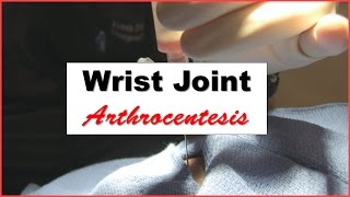 Wrist Joint Arthrocentesis Procedure [upl. by Jar]