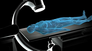 Non Cardiac Percutaneous Transluminal Angioplasty  NCPTA  Nucleus Health [upl. by Colley]