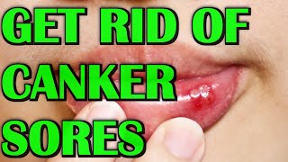 How To Get Rid of Canker Sores And Mouth Ulcers Fast [upl. by Andra895]