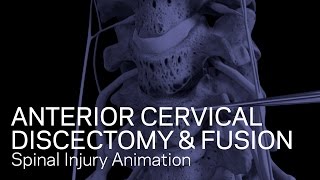 C56C67 Anterior Cervical Discectomy with Fusion [upl. by Eirret]