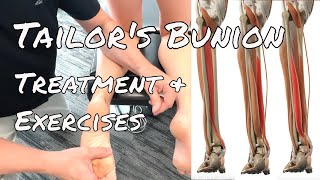 Tailors Bunion  Treatment amp Exercises [upl. by Sluiter]