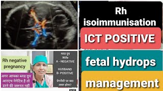 RH negative प्रेगनेंसी में ICT पॉजिटिव है ।अब क्या करें RH Isoimmunization amp fetal hydrops [upl. by Doris612]