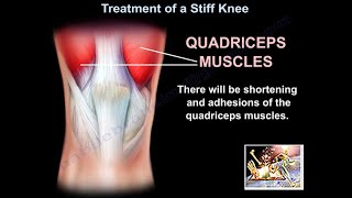 Treatment Of A Stiff Knee  Everything You Need To Know  Dr Nabil Ebraheim [upl. by Alic984]