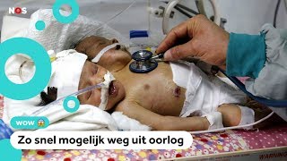 Hulp voor Siamese tweeling in oorlogsgebied [upl. by Oeht161]