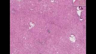 Histopathology LiverViral hepatitis [upl. by Aridaj390]