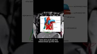 Kussmaul sign explained in less than 1 minute cardiology [upl. by Rehpinnej]