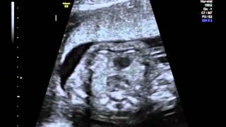 Overview of a fetal case of DORV subaortic VSD [upl. by Service218]