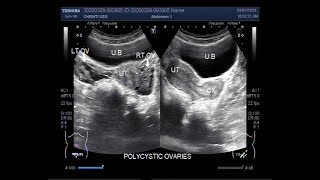 Ultrasound Video showing Another case of Polycystic ovary syndrome PCOS [upl. by Carew167]