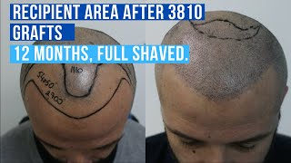 Hair Transplant Turkey 3810 Grafts No DHI Hair Transplant 2020 [upl. by Scoter457]