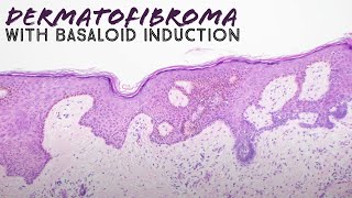 Dermatofibroma with basaloid follicular induction pathology mimic of basal cell carcinoma dermpath [upl. by Martinsen]