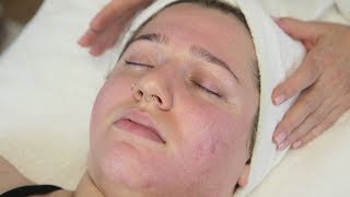 Facial Scarring Refinements The Lactic Peel [upl. by Eneryc996]