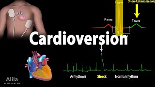 Cardioversion Electrical Procedure Animation [upl. by Milson376]