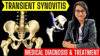 TRANSIENT SYNOVITIS  MEDICAL DIAGNOSIS amp TREATMENT by Dr Rupal Hindi 2021 [upl. by Yeniar]