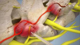 Endoscopic rhizotomy [upl. by Cadal]