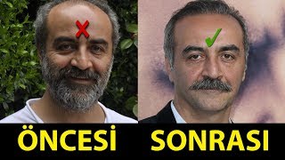 Saç Ektiren ve Protez Saç Kullanan Ünlüler Öncesi  Sonrası [upl. by Carlyn]