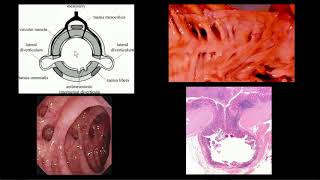 Doença diverticular do cólon [upl. by Sanfred]