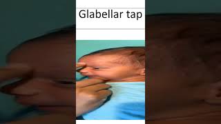 Glabellar Tap [upl. by Peppel9]