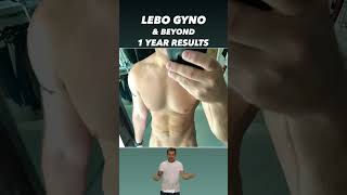 GYNECOMASTIA amp BEYOND SURGERY RESULTS 1 YEAR POSTOP gynosurgeon gynecomastia gynecomastiaresult [upl. by Zeitler]