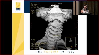 Atlantoaxial C1 C2 Subluxation in the Pediatric Population [upl. by Nalniuq]