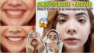 GENGIVOPLASTIA COM OSTEOTOMIA  FACETAS EM RESINA  Vídeo completo com ANTES e DEPOIS [upl. by Ima831]