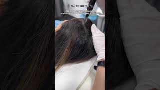 Calecim Advanced Hair System MicroNeedling at Dr MediSpa [upl. by Hoover741]