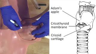 Emergency Needle Cricothyrotomy Procedure Explained [upl. by Isyak994]