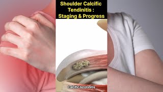 Shoulder Calcific Tendinitis  Progress and Staging [upl. by Asiek658]