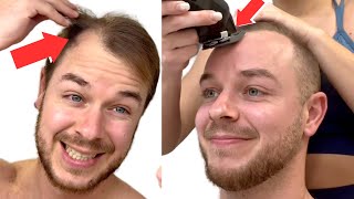 SHAVING My RECEDING HAIRLINE To A Grade 1 BUZZ CUT Transformation [upl. by Anaer]