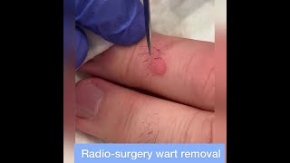 Wart Removal by Radiosurgery  Quick amp Thorough Removal of Stubborn Finger Warts [upl. by Namsu]