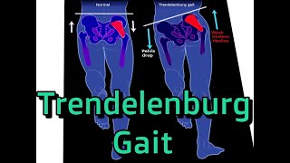 Trendelenburg Gait Explained and How to Fix [upl. by Manya]