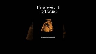 Unlocking the Secrets of the ThreeVessel and Trachea View in Fetal Echocardiography [upl. by Wilmer]