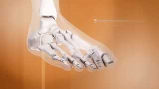 4 Lhallux valgus histoire évolutive et complications  Dr Coillard  Dr Boublil  Dr Grisard [upl. by Loria748]