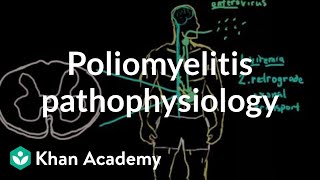 Poliomyelitis pathophysiology  Infectious diseases  NCLEXRN  Khan Academy [upl. by Recneps16]