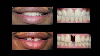 Invisaign for Teeth Gap Treatment at Cosmetic Dental Associates [upl. by Pierre]