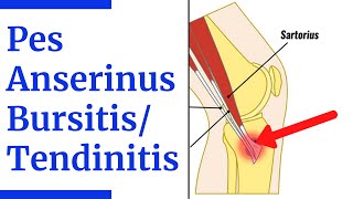 Pes Anserine BursitisTendinitis Evaluation [upl. by Linzer]