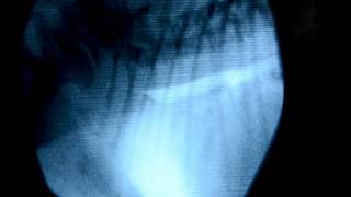 Colapso traqueal fluoroscopia y endoscopia [upl. by Magnus517]