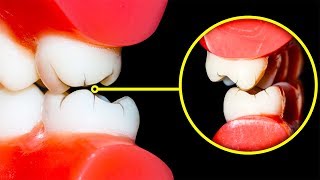 Bruxismo y Ansiedad  Rechinar los dientes [upl. by Randal]