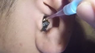 Mans Impacted Black Earwax Removal [upl. by Anikehs853]