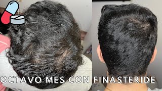 OCTAVO MES con FINASTERIDE 💊 [upl. by Kelwen222]