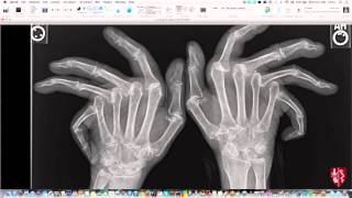 Introduction to Imaging of Arthritis [upl. by Nyrak]