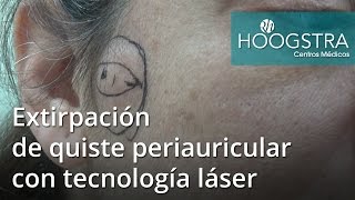 Extirpación de quiste periauricular con tecnología láser 16125 [upl. by Bliss]