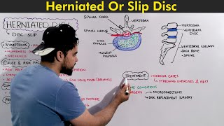 Herniated Disc  Slip Disc Symptoms Causes and Treatments [upl. by Nadda]