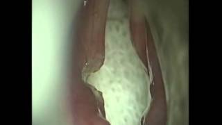 Left kashima cordotomy for bilateral vocal fold paralysis Dr Nupur Kapoor Nerurkar [upl. by Mart]