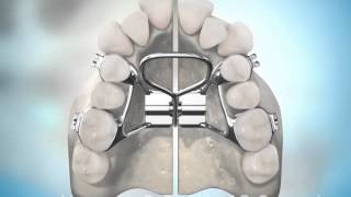 Surgically Assisted Palatal Expansion [upl. by Mukul487]