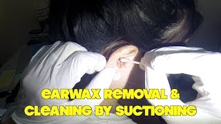 Earwax Removal amp Cleaning by Suctioning [upl. by Eelatan]